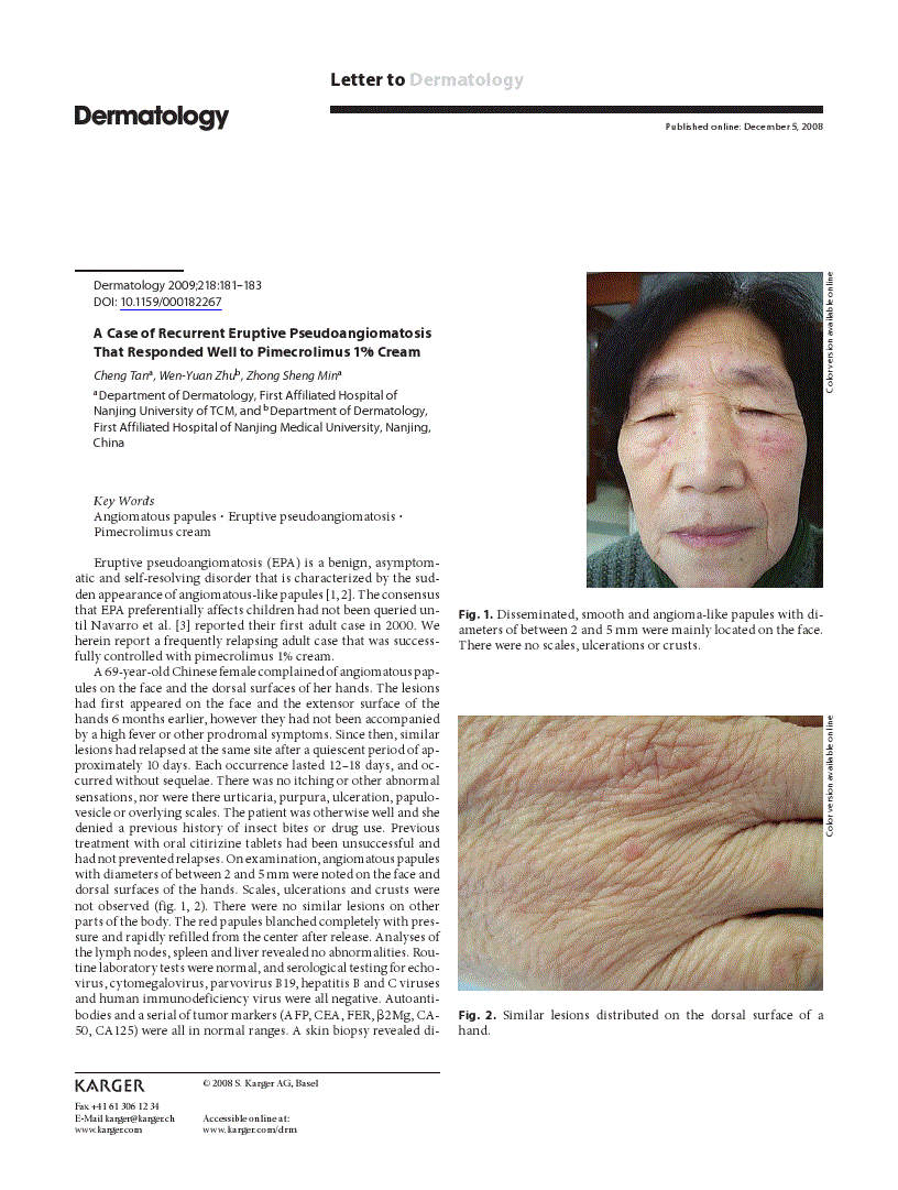 First page of A Case of Recurrent Eruptive Pseudoangiomatosis That Responded Well to Pimecrolimus 1% Cream