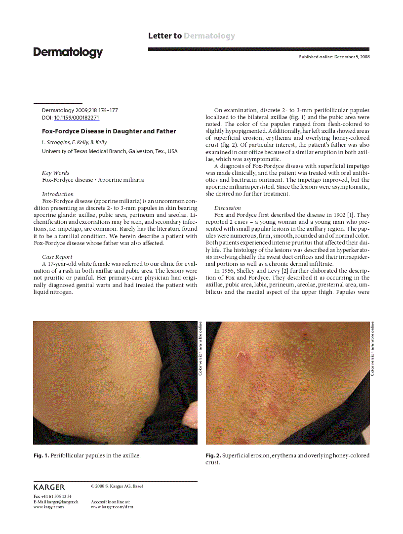 First page of Fox-Fordyce Disease in Daughter and Father