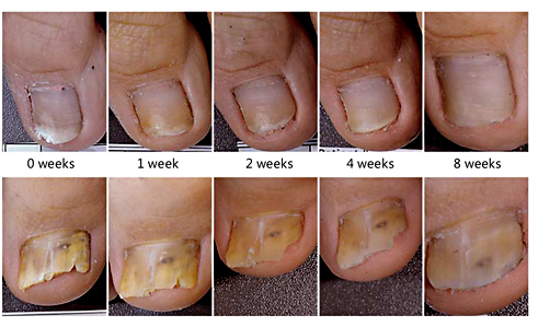 Fig. 3. Visible improvements in an onychomycosis-affected nail during 8 weeks of treatment with K101-03.