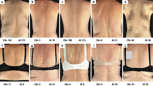  Images of back annotated with total body naevus counts by clinician in-clinic gold standard (Clin) and automated artificial intelligence counts (AI). Subjects in g and i had many seborrhoeic keratosis on their bodies, and AI varied proportionally the most.