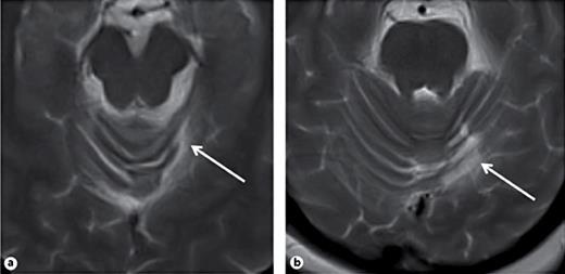 MRI of Cerebellar Infarction | European Neurology | Karger Publishers