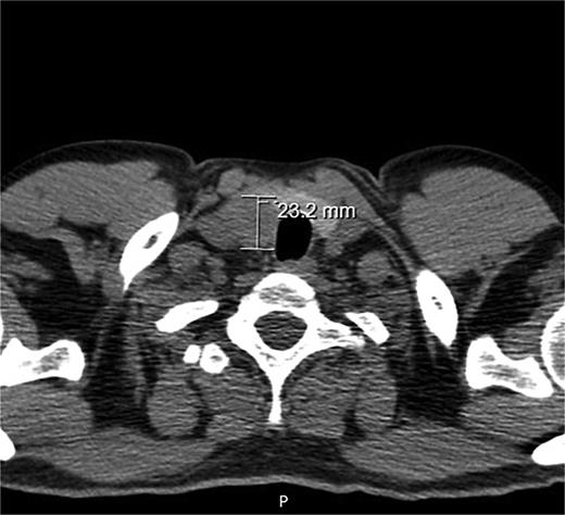 A neck CT scan showing a hypodense nodule posterior to the right thyroid lobe.