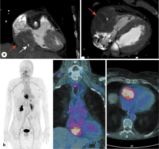 Fig. 2. a Cardiac CT in the coronal plane (left panel) and in the sagittal plane (right panel) showing the thyroid metastasis (red arrow) encasing the right ventricle and the right atrium with the right coronary artery (white arrow) encompassed by the tumor. b Planar image (left panel) and fused images (right panel) of an immuno-PET scan using an anti-CEA bispecific antibody and a 68Ga-labeled peptide revealing cardiac uptake of the metastatic lesion with a right lateral neck and mediastinal lymphadenopathies and a liver metastasis.
