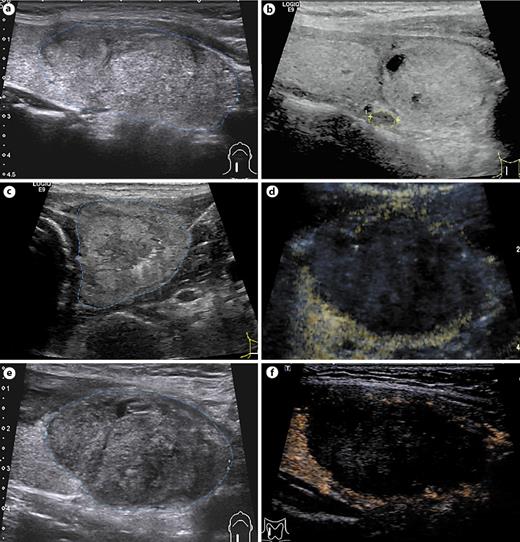 Fig. 2. A case of intermittent, repeated injection of 350 mL hydrodissection liquid. A 30-year-old female patient had a nodule in the right lobe of the thyroid. Preoperative fine-needle aspiration cytologic examination confirmed its benignancy. The blue line in the figure shows the rim of the nodule boundary. Preoperative images show that the rim of the 52 × 36 × 32 mm nodule was clear and smooth (a). Preoperative assessment of dangerous structures around the nodules. The nodule was adjacent to the cervical sympathetic nerve node, recurrent laryngeal nerve, trachea, and esophagus, and the yellow line shows the posterior cervical sympathetic ganglion (b). Glucose (5%) was injected to separate the nodule and the surrounding structures at a distance of &gt;3 mm (c). After assurance of a sufficient safety buffer, multiple ablations were performed until the nodule was completely covered by a transient hyperechoic area in three-dimensional space. Then, CEUS was performed again to confirm that the nodule had been completely ablated (d). One-day US images showed that the hydrodissection liquid was absorbed completely (e). One-month US images showed that the nodule achieved complete ablation and was reduced to 44 × 32 × 10 mm (VRR = 56.5%) (f). CEUS, contrast-enhanced ultrasonography; US, ultrasonography; VRR, volume reduction ratio.