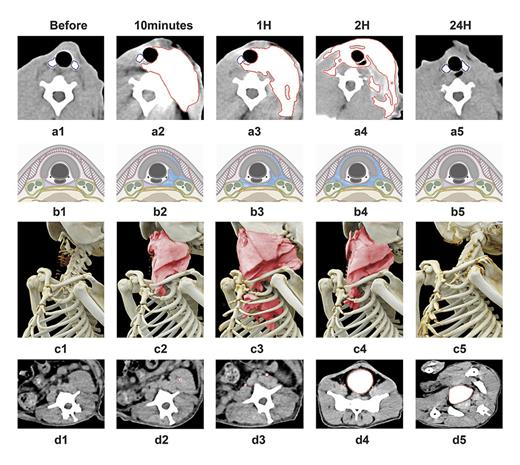 Fig. 3. CT and reconstruction images of the 22-year-old rhesus monkey (weight = 10 kg) after injecting 20 mL hydrodissection liquid (10 mL 5% glucose and 10 mL iohexol) around the left thyroid lobe. a: CT images of the neck. a1–a5 show that 10 min to 2 h after injection, liquid spread around the visceral space and extended to the retropharyngeal space and the opposite side. Twenty-four hours after liquid injection, no liquid remained in the neck. b: schematic diagrams of the neck corresponding to a1–a5. c: reconstruction images of the chest. c1–c5 show that 10 min to 2 h after injection, liquid spread around the visceral space and extended to the mediastinum. Twenty-four hours after liquid injection, no liquid remained in the chest. d: CT images of the abdomen. d1–d5 show that 10 min to 2 h after injection, the kidneys, ureters, and bladder were enhanced by hydrodissection liquid absorption. Twenty-four hours after liquid injection, the bladder was still enhanced as a result of residue iohexol.