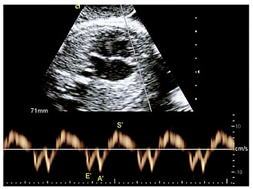 Assessment of Fetal Cardiac Function Using Tissue Doppler Techniques ...