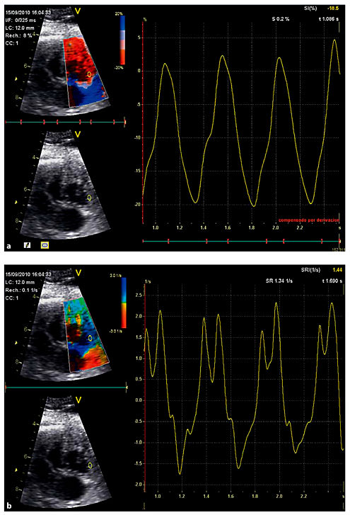 Assessment of Fetal Cardiac Function Using Tissue Doppler Techniques ...