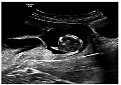 Fig. 5. Transcervical CVS on triplet. Catheter with stylet in place seen as a white line traversing lower placenta.