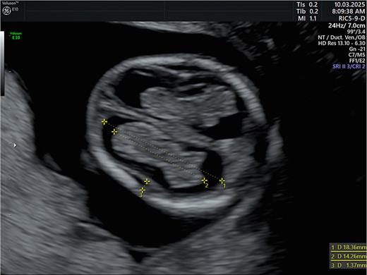 Advanced exploration. Transventricular axial section. 1. +....+ lateral ventricle length (maximum length) (VL). 2. +....+ choroid plexus length (maximum length) (PL). 3. +....+ insula (in to in: from occipital bone to maximum indentation of the insula).