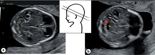 Advanced exploration. a Transcerebellar axial. b Posterior fossa axial. a. Transcerebellar (oblique axial): 1+...+: transcerebellar diameter (TCD) cerebellar hemispheres (C). b Posterior fossa (parallel and inferior to a): Choroid plexus of the IVV (PC). 1 +...+ IV ventricle (IVV) space between the brain stem and PC, from inside to inside. 2 +...+ cisterna magna (CM) (from PC to internal border of occipital bone). In to in.