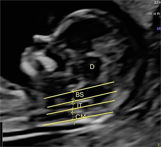 Advanced exploration, sagittal section. D, 4-line, 3-space visualization diencephalon; BS, brain stem; IT, IV ventricle or intracranial translucency; CM, cisterna magna; Oc, occipital bone.