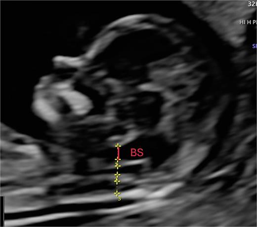 Advanced exploration, sagittal section. BS measurement: from the posterior border of the sphenoid to the anterior border of the intracranial translucency (IT). BS, brain stem.