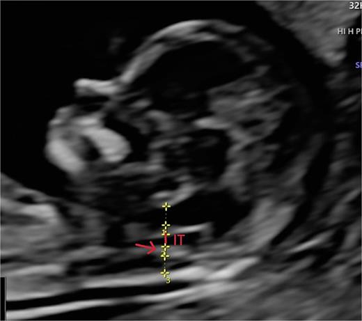 Advanced exploration, sagittal section. IT, IV ventricle or intracranial translucency (IT). IT measurement: from the posterior border of the brain stem to the choroid plexus of the IV V (PC).