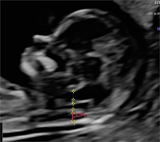 Advanced exploration, sagittal section. CM measurement: from the posterior edge of the choroid plexus of the IV V to the inner edge of the occipital bone. CM, Cisterna magna.