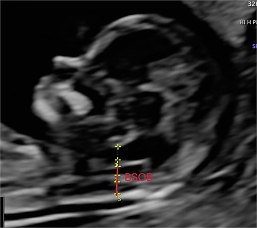 Advanced exploration, sagittal section. BSOB distance. BSOB distance measurement: includes the intracranial translucency (IT) and the cisterna magna (CM). From the anterior edge of the IT to the internal edge of the occipital bone.