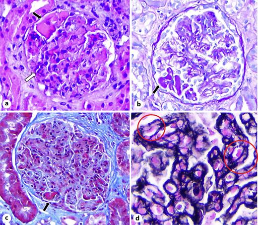 a Glomeruli exhibiting a lobular appearance due to endocapillary and mesangial proliferation (white arrow) with segmental pseudothrombi (black arrow) (hematoxylin-eosin stain, ×20). b Pseudothrombi are positively stained with periodic acid-Schiff (PAS stain, ×20). c Fuchsinophilic capillary wall pseudothrombi (Masson trichrome stain, ×20). d Double contours of the glomerular basement membranes (red circle) (Jones silver stain, × 20).