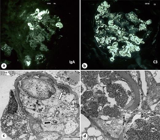 a, b Immunofluorescence staining reveals IgA and C3 positivity in pseudothrombi (original magnification ×4,000). c EM shows doubles contours of the glomerular basement membranes (black arrow) and subendothelial electron-dense deposits (white arrow). d Intravascular immunotactoid deposits which occlude the vascular lumens (original magnification ×30,000). The image on the right displays a higher magnification view, revealing disorganized arrangement of tangle-like or tubular structures, with mean thickness of 29,94 nm (original magnification ×40,000).