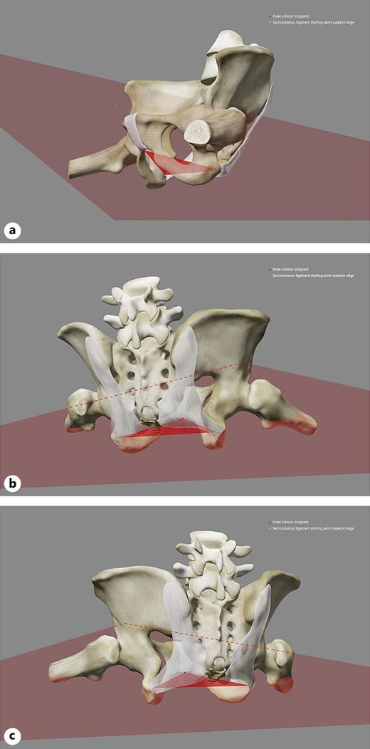 Geometric shapes of visualized bone structures and selection of reference point positions lateral view (a); frontal view (b, c).