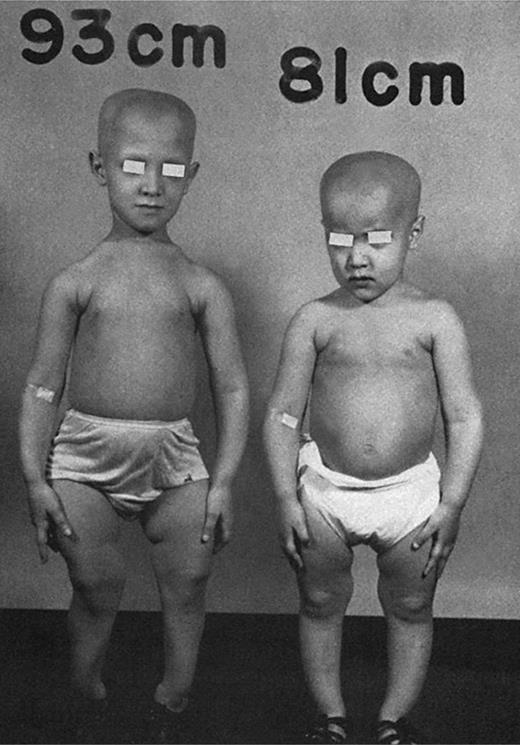 Rickets, Vitamin D, and Ca/P Metabolism | Hormone Research in ...