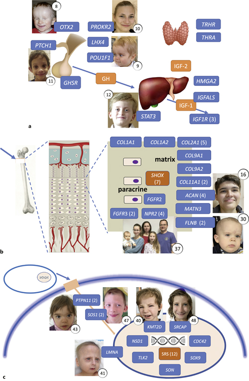 Three levels of the genetic growth regulation in children born small for gestational age with persistent short stature (SGA-SS). The numbers in brackets in blue boxes show the numbers of patients identified with P/LP variants of the entire gene (if more than one). The numbers in closed circles refer to patient numbering in Table 1. a Genes involved in cerebral midline and pituitary development, and in the GH-IGF-1 and thyroid axes. b Genes encoding growth plate matrix components and elements of chondrocyte paracrine regulation. c Genes involved in intracellular signalling, in the stability of nuclear membrane, and in the fundamental intranuclear processes. A brief description of selected patients’ facial phenotypes: (8) OTX2: bilateral anophthalmia; (9) POU1F1: depressed nasal bridge and frontal bossing; (10) PROKR2: no apparent facial dysmorphism; (11) PTCH1: mild orbital hypotelorism, midface hypoplasia, and anteverted ears; (12) STAT3: no specific facial signs in a boy with severe immune dysregulation leading to early onset diabetes, hypothyroidism, cytopenia and lymphoproliferation, and short stature due to defective STAT3 signalling; (16) ACAN: mild facial dysmorphism similar to previously published cases; (30) FLNB: facial phenotype of atelosteogenesis type I – prominent forehead, depressed nasal bridge with a grooved tip, and micrognathia; (37) NPR2: the father and two daughters with vertical transmission of an NPR2 pathogenic variant, no facial phenotype; (40) KMT2D: Kabuki syndrome resembling the makeup in traditional Japanese theatre; (41) LMNA: gradually developing phenotype of Hutchinson-Gilford progeria syndrome; (43) PTPN11 and (47) SOS1: facial signs of Noonan syndrome; (48) SRCAP: typical face of Floating-Harbour syndrome. Image adapted from [25].