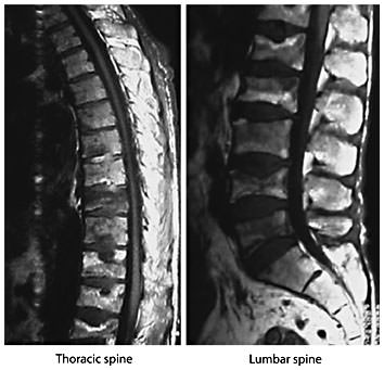 Fig. 3. Magnetic resonance images of the thoracic and lumbar spine. Magnetic resonance study of the thoracic and lumbar spine of a man with multiple vertebral fractures due to osteoporosis. Courtesy of Prof. Dr. H. Resch, Department of Medicine 2, St. Vincent Hospital, Vienna.