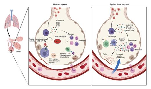 Fig. 2. SARS-CoV-2 pathogenesis. SARS-CoV-2 infects alveolar epithelial cells, which express ACE2 and TMPRSS2. During this active replication cycle, alveolar epithelial cells, macrophages, and endothelial cells detect viral PAMPs (viral RNA) and damage-associated molecular patterns, such as ATP and nucleic acids, through PRRs such as TLR7. This leads to TLR downstream signalling evoking proinflammatory cytokine production such as IL-6, IP-10, MIP1α, MIP1β, and MCP1. This proinflammatory environment recruits peripheral immune cells such as macrophages, monocytes, and T cells to site of infection, which heightens the inflammatory state within the site of infection. Inflammation is further heightened by the release of IFNϒ, which elicits a positive proinflammatory feedback loop. In a healthy response (left), this inflammatory state recruits SARS-CoV-2-specific T cells to site of infection. CD8+ cytotoxic cells (CTLs) recognize SARS-CoV-2 peptides, presented via class I MHC molecules, on type II pneumocytes. This causes CTLs to release IFNϒ, perforin, and granzyme B which eliminates SARS-CoV-2-infected pneumocytes, thus preventing viral spread. CD4+ T cells, especially Tfh, provides T cells help to B cells which stimulates neutralizing antibody production to SARS-CoV-2, consequently blocking viral infection. Furthermore, alveolar macrophages phagocytose both neutralized SARS-CoV-2 and apoptotic cells. Cumulatively, these cellular mechanisms lead to viral clearance with minimal upper respiratory damage, leading to resolution. Dysfunctional responses (right), which is marked by lymphopenia and CD4+ apoptosis, is characterized by a polyclonal antibody response, which is ineffective against neutralizing SARS-CoV-2. Furthermore, increased amounts of exhausted T cells express PD-1, which contributes to decreased proliferation and cytofunctionality of CD8+ T cells. Such impaired cytotoxicity results in chronic viral shedding, which exacerbates macrophage activation, leading to massive cytokine production, referred to as cytokine storm. Such deleterious uncontrolled inflammation leads to ARDS. Overall, chronic viral replication along with hyperinflammation leads to systemic vascular damage and disseminated intravascular damage, causing multiorgan failure and fatality. SARS-CoV-2, severe acute respiratory syndrome coronavirus 2; ACE2, angiotensin-converting enzyme 2; TMPRSS2, transmembrane protease serine 2; PAMPs, pathogen-associated molecular patterns; RNA, ribonucleic acid; ATP, adenosine triphosphate; TLR, Toll-like receptor; IL-6, interleukin-6; IP-10, interferon ϒ-induced protein 10; MIP1α, macrophage inflammatory protein 1-alpha; MIP1β, macrophage inflammatory protein 1-beta; MCP1, monocyte chemotactic protein-1; PD-1, programmed cell death protein-1; ARDS, acute respiratory distress syndrome. Images created with BioRender.com.