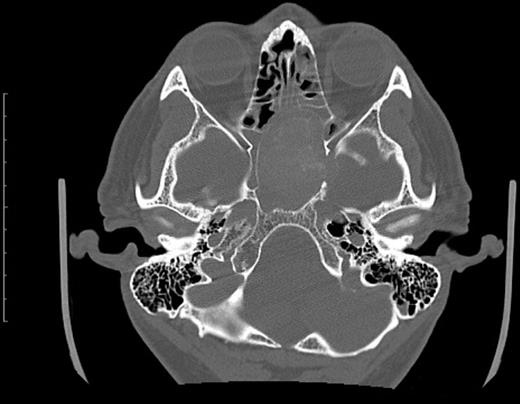 Computed tomography of the paranasal sinuses prior to the surgery. CT scan shows complete shadowing of the left sphenoid sinus.