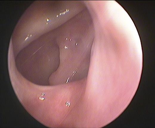 Endoscopic examination of the sphenoethmoidal recess revealing no abnormalities of the operated sinus.
