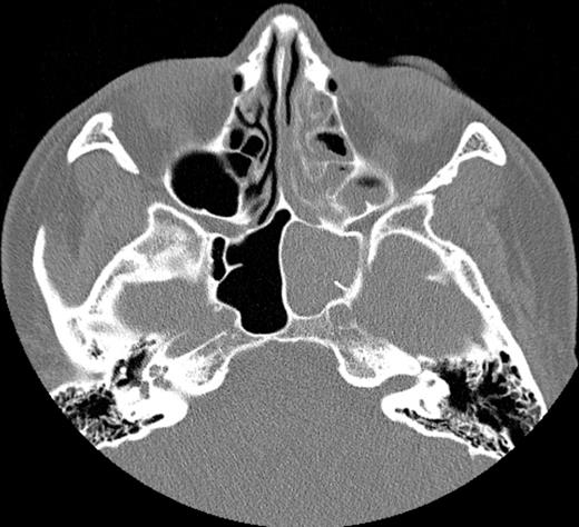 Computed tomography of the paranasal sinuses shows opacity of the ethmoid cells and sphenoid sinus on the left side.