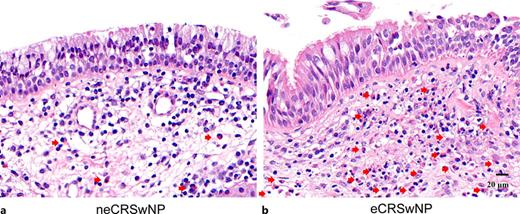 Representative HE-stained images of neCRSwNP (a) and eCRSwNP (b). Eosinophils are marked by red arrows.