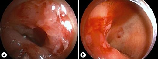 a, b An ulcerated stricture with active oozing; no intervention was performed at this stricture. The patient was treated with intravenous hydrocortisone, which stopped the bleeding. The patient continued ustekinumab medical therapy and is scheduled for a repeat retrograde DBE with EBD.