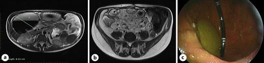 a Axial T2 sequence showing upstream jejunal dilatation of 8 cm proximal to a stricture in the distal jejunum (green measurement marker). b An axial T2 sequence shows one of the many strictures in the ileum with a concentric bowel wall thickening (green arrow). c Endoscopic images showing the ability of the enteroscope to retroflex in the severely dilated segment.