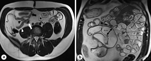 a Axial T2 sequence demonstrating fistulation (black arrowhead) between the terminal ileum (white arrowhead), distal ileum (black arrow), and the sigmoid colon (white arrow). b Coronal T2 sequence demonstrating upstream ileal dilatation to 4 cm proximal to the stricture (black arrow).