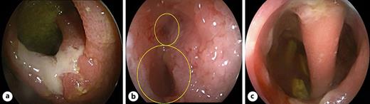 a Severely ulcerated stricture in the distal ileum. b Strictured lumens in the distal ileum prior to dilatation. c After dilatations of both strictures, multiple lumens were found, including the ileal lumen and a fistular lumen connected to the sigmoid.