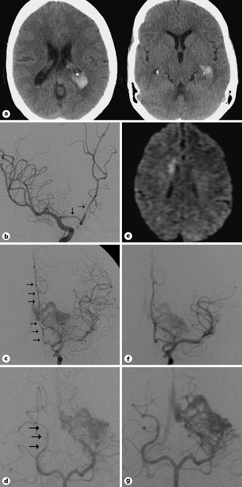 Fig. 2. This middle-aged patient presented to the emergency room with severe headache. CT of the head (a) showed an isolated intraventricular hemorrhage within the bilateral lateral ventricles (left greater than right). DSA on postbleed day 7 (b–d) of the bilateral internal carotid arteries and the left vertebral artery shows vasospasm of the proximal right anterior cerebral artery (ACA) (b), the entire left ACA (c), and the P2-P3 segments of the right PCA (arrows) (d). Note the left occipital-temporal region AVM nidus with arterial supply from the left PCA. e MRI on postbleed day 15 shows DWI intensity in the medial right frontal lobe. f, g Follow-up DSA several weeks after the hemorrhage shows resolution of the ACA and PCA vasospasm. The patient underwent successful nBCA embolization and stereotactic radiosurgery of the AVM.