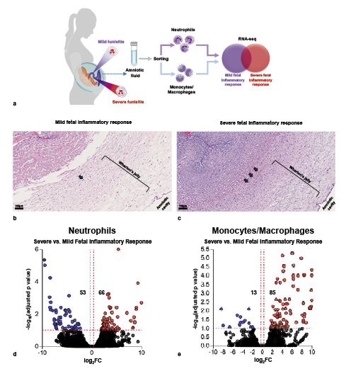 Fig. 4. Transcriptomic differences between amniotic fluid neutrophils or monocytes/macrophages from cases of severe and mild fetal inflammatory response. a Experimental design demonstrating the transcriptomic comparison of amniotic fluid neutrophils or monocytes/macrophages between cases of mild (n = 2) and severe (n = 4) fetal inflammatory response. b, c Representative images of umbilical cord hematoxylin and eosin (H&E) staining showing mild (b) and severe (c) fetal inflammatory response indicated by leukocyte infiltration in the Wharton’s jelly localized near the umbilical artery (arrows). Magnification = ×10, scale bar = 100 μm. d, e Volcano plots showing the differentially expressed genes among amniotic fluid neutrophils (d) and monocytes/macrophages (e) from cases of severe fetal inflammatory response compared to those from cases of mild fetal inflammatory response. FC, fold change.