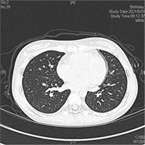  Der HRCT-Scan des Brustkorbs zeigt eine Verdickung des Herzbeutels mit leichtem Perikarderguss. Es gibt keine eindeutigen Hinweise auf Lungenknötchen und damit verbundene Pleuraergüsse. Weder Bronchiektasien noch Bereiche mit Lufteinschlüssen wurden nachgewiesen.