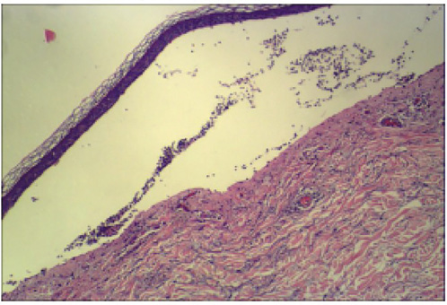  Repräsentatives Bild (40×) der H&E-Färbung. Die Biopsie zeigt eine subepidermale Blase mit neutrophilen Infiltraten und eine Infiltration von Lymphozyten und Neutrophilen um die oberflächlichen Gefäße in der Dermis.