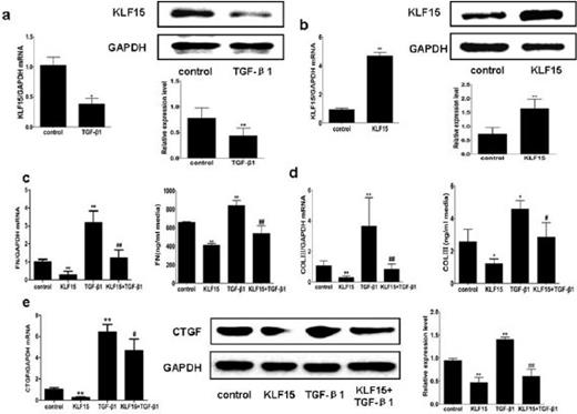 Fig. 3. KLF15 is downregulated by TGF-β1 and overexpression of KLF15 represses extracellular matrix and CTGF. TGF-β1 downregulated KLF15 mRNA and protein expression (a), KLF15 mRNA and protein expression after KLF15 adenoviral transduction (b), and overexpression of KLF15 inhibited basal and TGF-β1-induced fibronectin (c), type III collagen (d) and CTGF (e) mRNA and protein expression in NRK-49F cells. Cells were collected for determining mRNA levels by real-time PCR and protein levels by western blot. Additionally, fibronectin and type III collagen produced in the supernatant were measured by ELISA. Data are mean ± SD, *P<0.05, **P<0.01 versus control group, #P<0.05, ##P<0.01 versus TGF-β1 treated group. n≥3, each experiment was performed in triplicate.