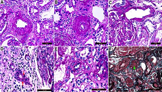 Fig. 1. Arterial lesions in IgA nephropathy. (A) The interlobular artery shows intimal arterial fibrotic intimal thickening and lumen narrowing. The thickness of the intima is less than the thickness of the media in this vessel, thus scoring as 1 (PAS stain). (B) This interlobular artery also shows fibrotic intimal thickening, but the intima has thickened to more than the thickness of the media in this vessel. The fibrotic intimal thickening score for this vessel is 2 (PAS stain). (C) The presence of arteriolar hyaline, shown as homogeneous pink hyaline material, is identified on the walls of this artery (PAS stain). (D) Inflammatory cells (red arrows), stained as blue nucleus by hematoxylin, infiltrate around the walls of this arteriole (PAS stain). (E) Endotheliocyte swelling is presented on the wall of the arteries or arterioles (PAS stain). (F) The arteriole with microthrombosis (green triangle) is shown (trichrome-methenamine stain). Scale bars represent 50 μm.