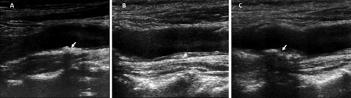Fig. 1. Sagittal ultrasound and Doppler of carotid artery demonstrating lesion suggestive of carotid plaque (arrow) in a patient without renal disease (A), and increased carotid intima-medium thickness (*) and calcified carotid plaque (arrow) in a patient with CKD (B, C). Data obtained by our research unit.