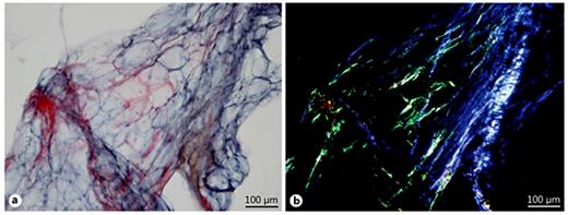 Fig. 1. A subcutaneous abdominal fat specimen containing amyloid deposits, stained with Congo red. a Amyloid deposits are stained red when observed in bright light. b Amyloid deposits show green birefringence when observed in polarized light (collagen is bluish-grey). Scale bar = 100 µm.