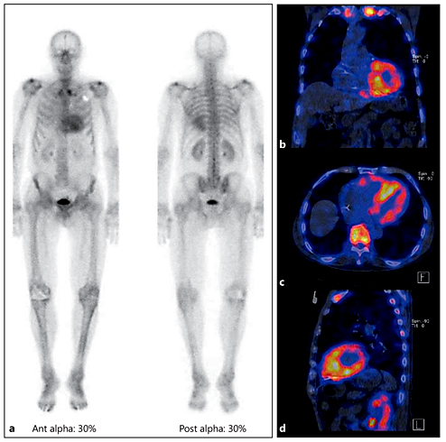 Fig. 2. Technetium (99mTc)-hydroxymethylene diphosphonate bone scintigraphy in a 71-year-old man with wild-type ATTR amyloidosis. a Total body scan with increased cardiac uptake and soft tissue uptake. The skeletal uptake is relatively diminished. Coronal (b), transverse (c), and sagittal (d) single photon emission computed tomography/CT images of the heart showing increased uptake in mainly the left but also the right ventricular wall. Ant = Anterior view; Post = posterior view.