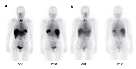 Fig. 3. Total body 123I-SAP scintigraphy (anterior and posterior images) of a 48-year-old woman with systemic AL amyloidosis. a At the start of treatment, scintigraphy shows increased uptake in the liver (+++) and spleen (+++). Nonspecific uptake can be seen in the thyroid gland, nasopharynx, and stomach. b Two years after successful chemotherapy resulting in complete response, the SAP scan shows clear improvement with some residual uptake in the liver (+) and spleen (+). Ant = Anterior view; Post = posterior view.