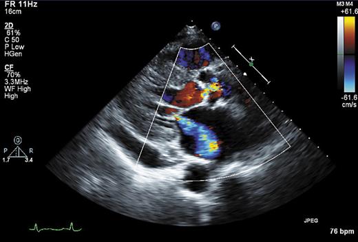 Fig. 1. Typical picture of mitral regurgitation.