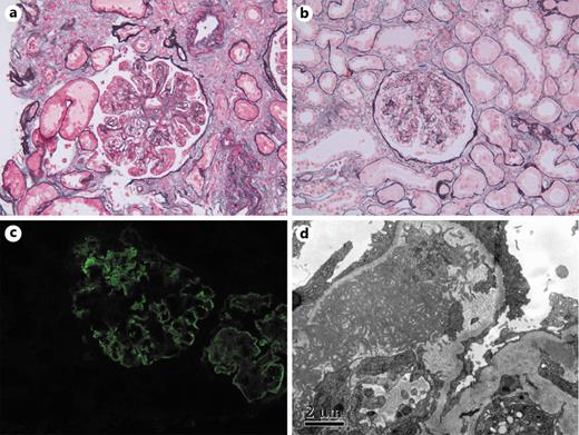 Fig. 2. a–d The histopathological findings of Cryo-GN. Light microscopy showed typical MPGN with endocapillary proliferation, typical double contours, and Ig-related protein thrombi in the capillary lumen (a, periodic acid-silver methenamine + Masson trichrome staining, ×200); and a case with EPGN lesion (b, periodic acid-silver methenamine + Masson trichrome staining, ×200). Immunofluorescence staining revealed granular IgM deposition in the mesangial area and capillary wall (c, ×200), IgG, and both κ and λ light chains were also detected in a similar pattern (data not shown). Electron microscopy showed short microtubule and fibrillary substructure of subendothelial deposits (d, ×12,000).