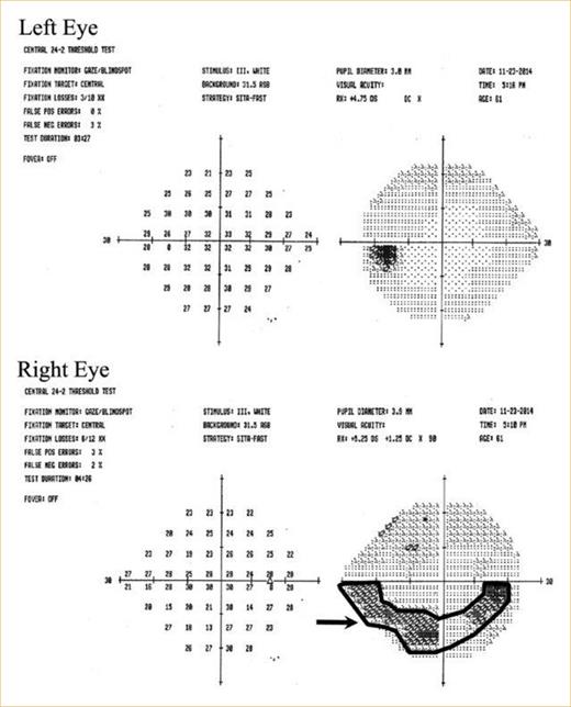 Fig. 1. Die Gesichtsfeldmessung (SITA 24-2) bei der Erstvorstellung ergab einen superioren bogenförmigen Defekt (Pfeil) im rechten Auge.