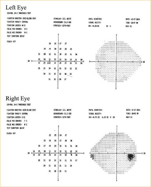Fig. 2. Die Gesichtsfeldmessung (SITA 24-2) bei der Kontrolluntersuchung nach 6 Wochen zeigte die beidseitige vollständige Wiederherstellung des Gesichtsfelds.