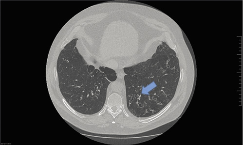  CT-Siegelringzeichen bei Bronchiektasen. Das «Siegelringzeichen» ist das am weitesten verbreitete radiologische Kriterium für die radiologische Diagnose von Bronchiektasen. Es ist definiert als ein Lumendurchmesser, der größer ist als der der zugehörigen Lungenarterie.