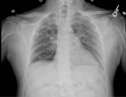  Thorax-Röntgenaufnahme von posteroanterior (PA) mit Darstellung der Fibrose und Nodularität.